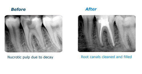 before-after-root-canal