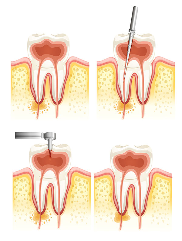 root canal cambridge
