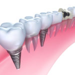 Average Cost of a Dental Implant